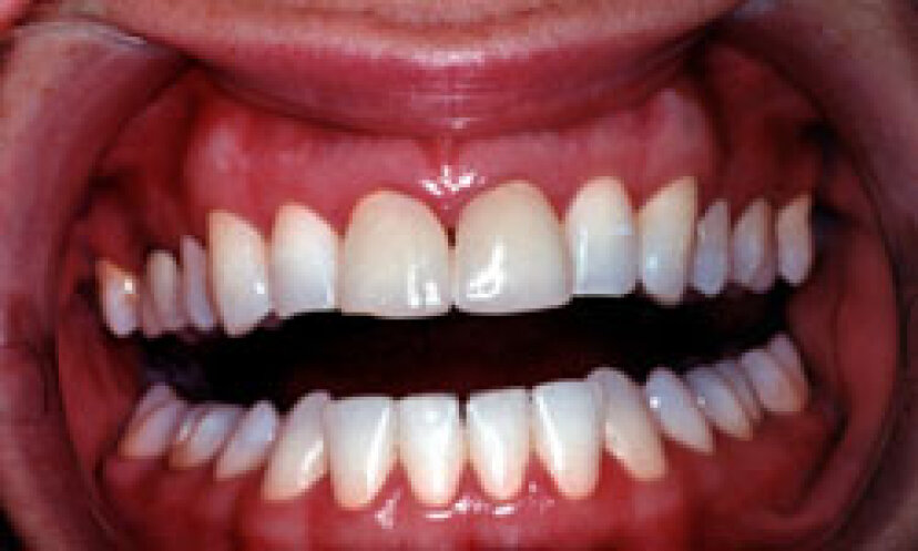 5 Erklärungen für Zahnfleischbluten