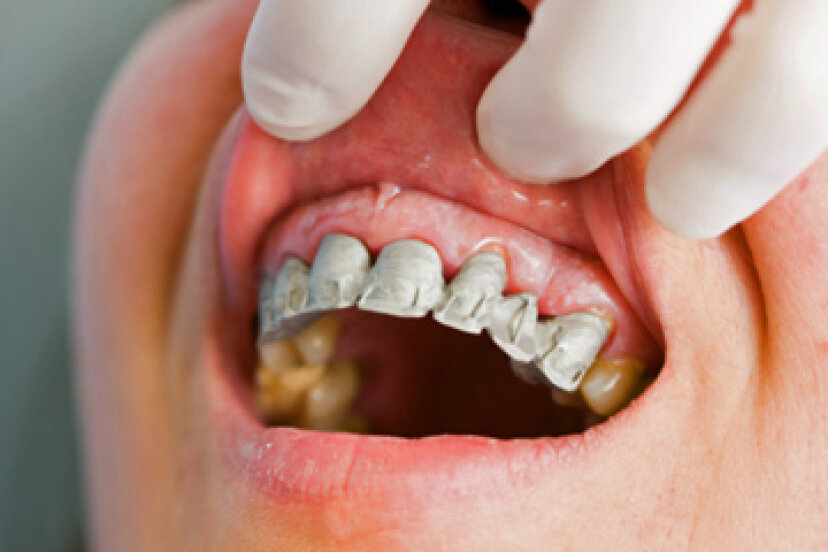 Warum blutet mein Zahnfleisch beim Zähneputzen?