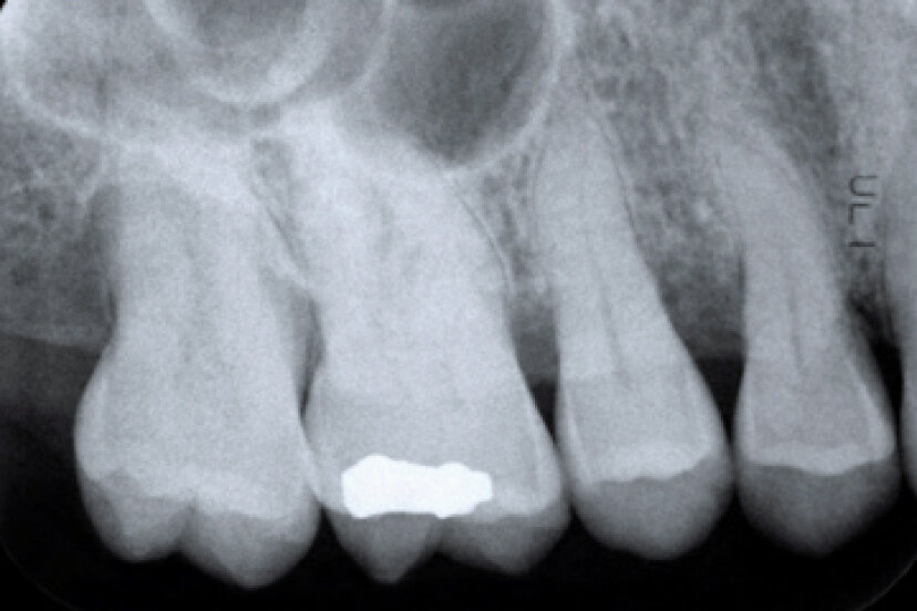 ¿Cómo se forman las caries en los dientes?