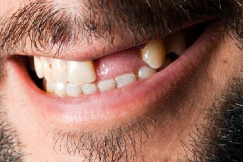 Welche Krankheiten gehen mit Zahnverlust einher?