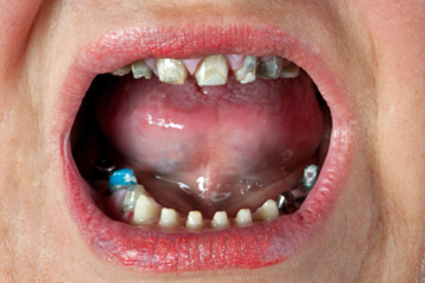 Was passiert, wenn Sie Ihre Zähne nicht putzen?