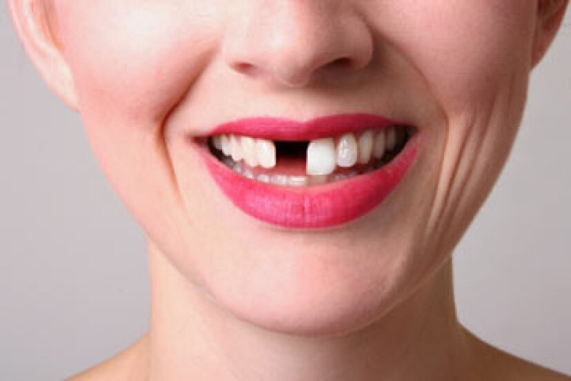 ¿Qué son los dientes de aleta?