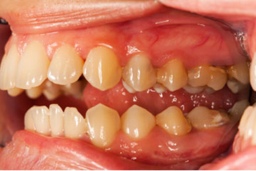 Ist Zahnfleischentzündung ansteckend?