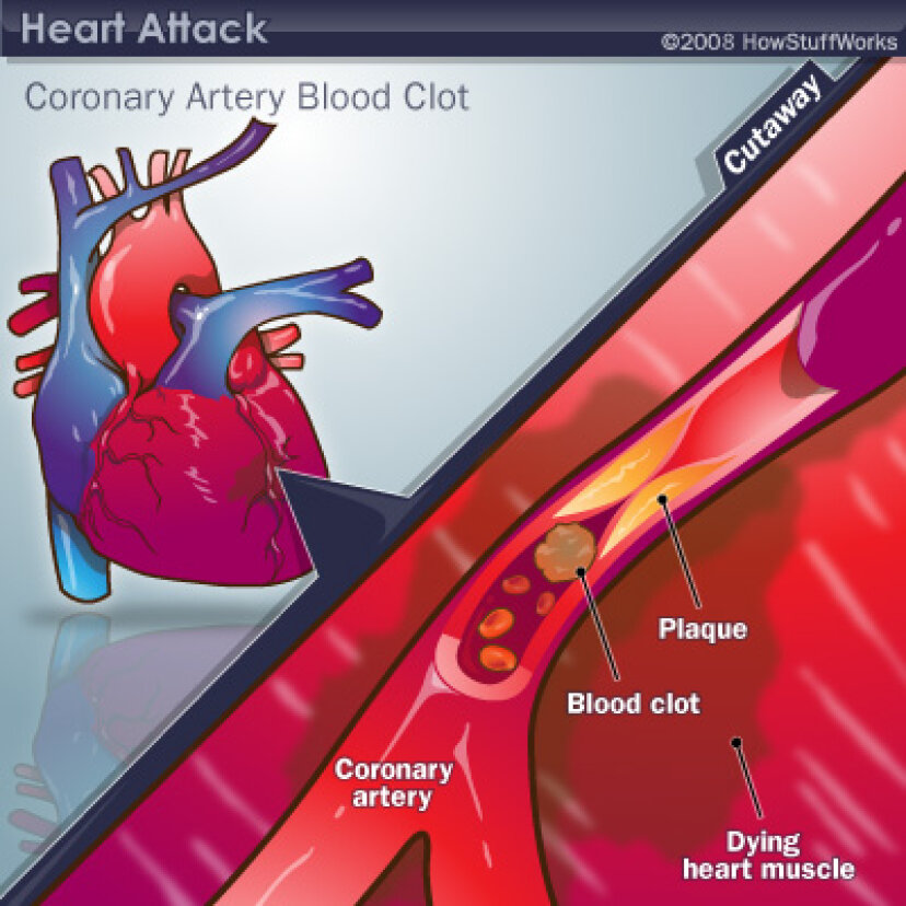 Czy możesz mieć atak serca – i nie wiedzieć o tym?